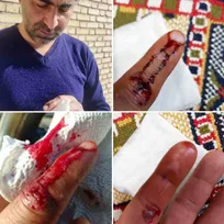 یکی از کارکنان دامپزشکی فلاورجان حین انجام واکسیناسیون هاری، بر اثر گاز گرفتگی سگ از ناحیه دست مصدوم شد