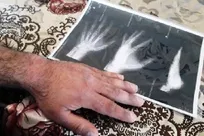 دست یکی از دامپزشکان بخش دولتی رزن در حین تست سل و بروسلوز در گاوداری دچار شکستگی شد
