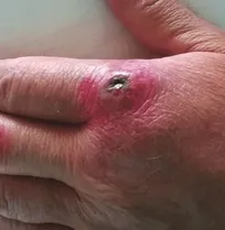شیوع سیاه&zwnj;زخم در یکی از روستاهای خمین/ سه نفر در این روستا با ذبح گوسفند به بیماری مبتلا شدند