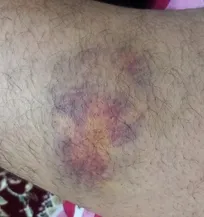 واکسیناتور مرکز مایه&zwnj;کوبی بخش خصوصی شهرستان میاندوآب بر اثر ضربه لگد گاو مصدوم شد/ عدم مراجعه به بیمارستان و درمانگاه به علت درآمد پایین و نداشتن بیمه